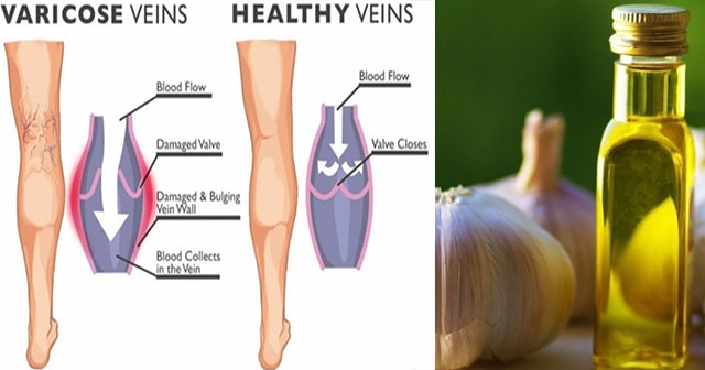 Prevent Pain and Inflammation of your Varicose Veins with Homemade Garlic Oil ~ Learn Here